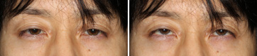 眼瞼下垂症/症例1/術前正面視